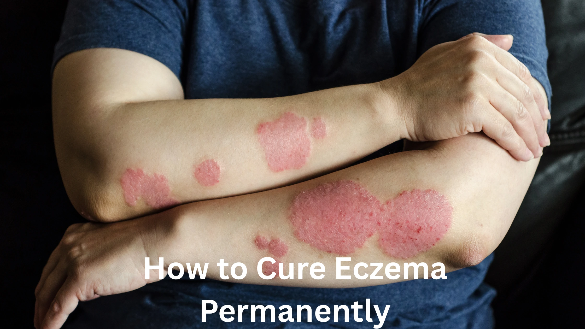How to Cure Eczema Permanently