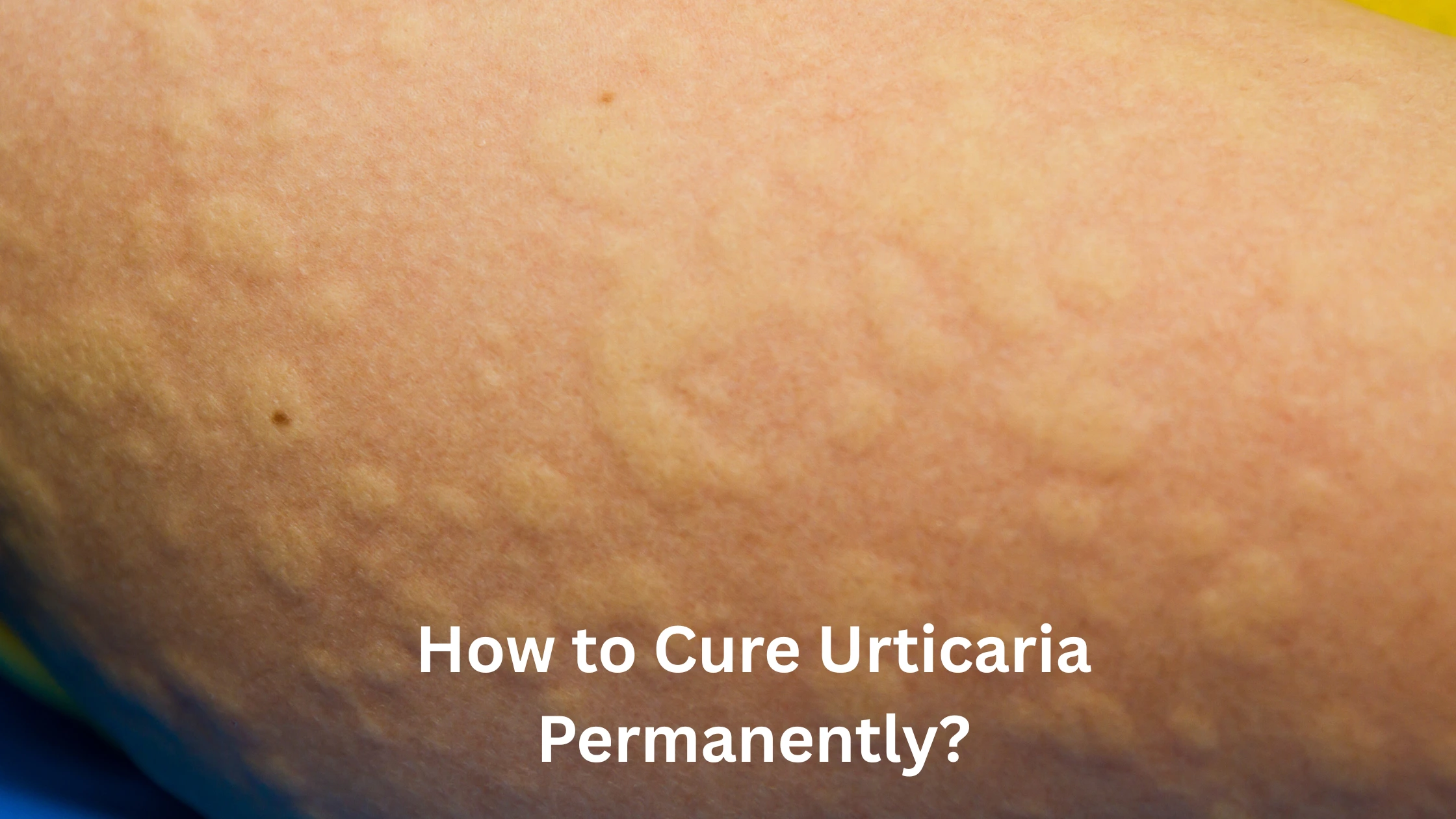 How to Cure Urticaria Permanently?