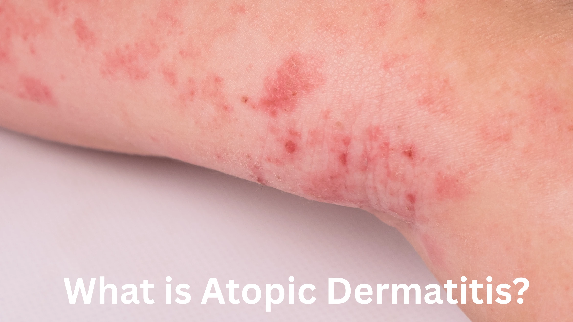 What is Atopic Dermatitis?