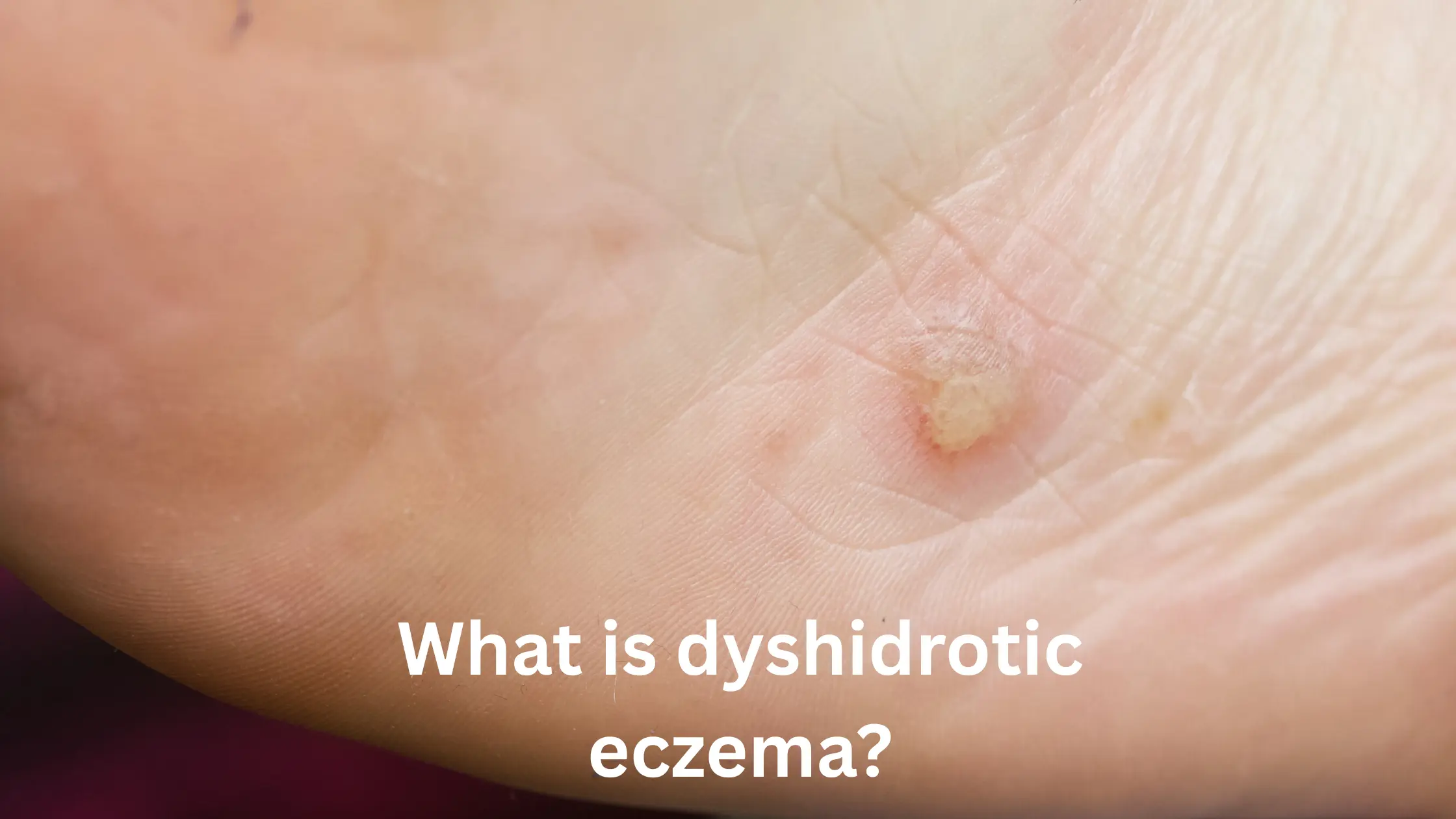 What is dyshidrotic eczema?