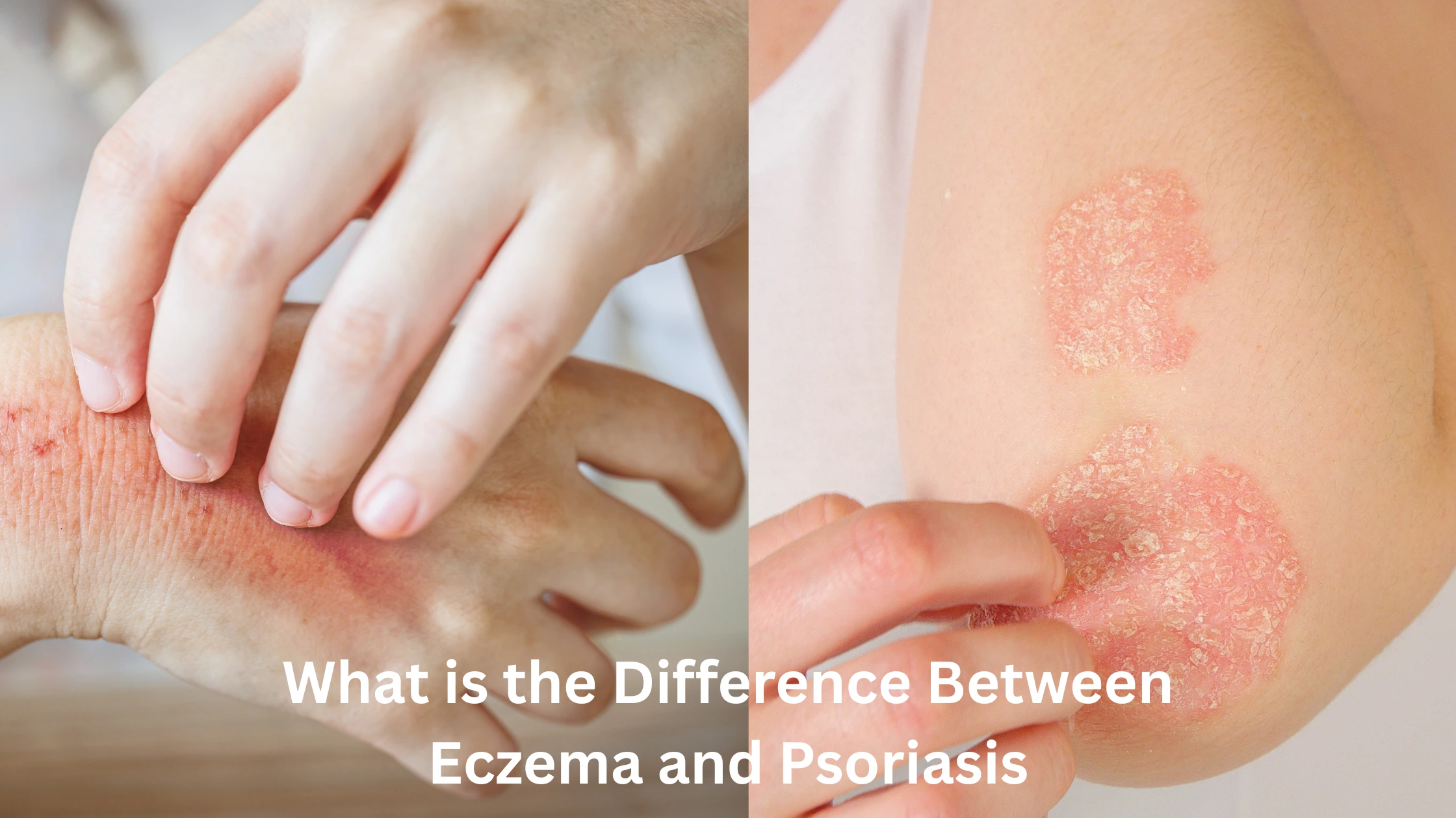 What is the Difference Between Eczema and Psoriasis