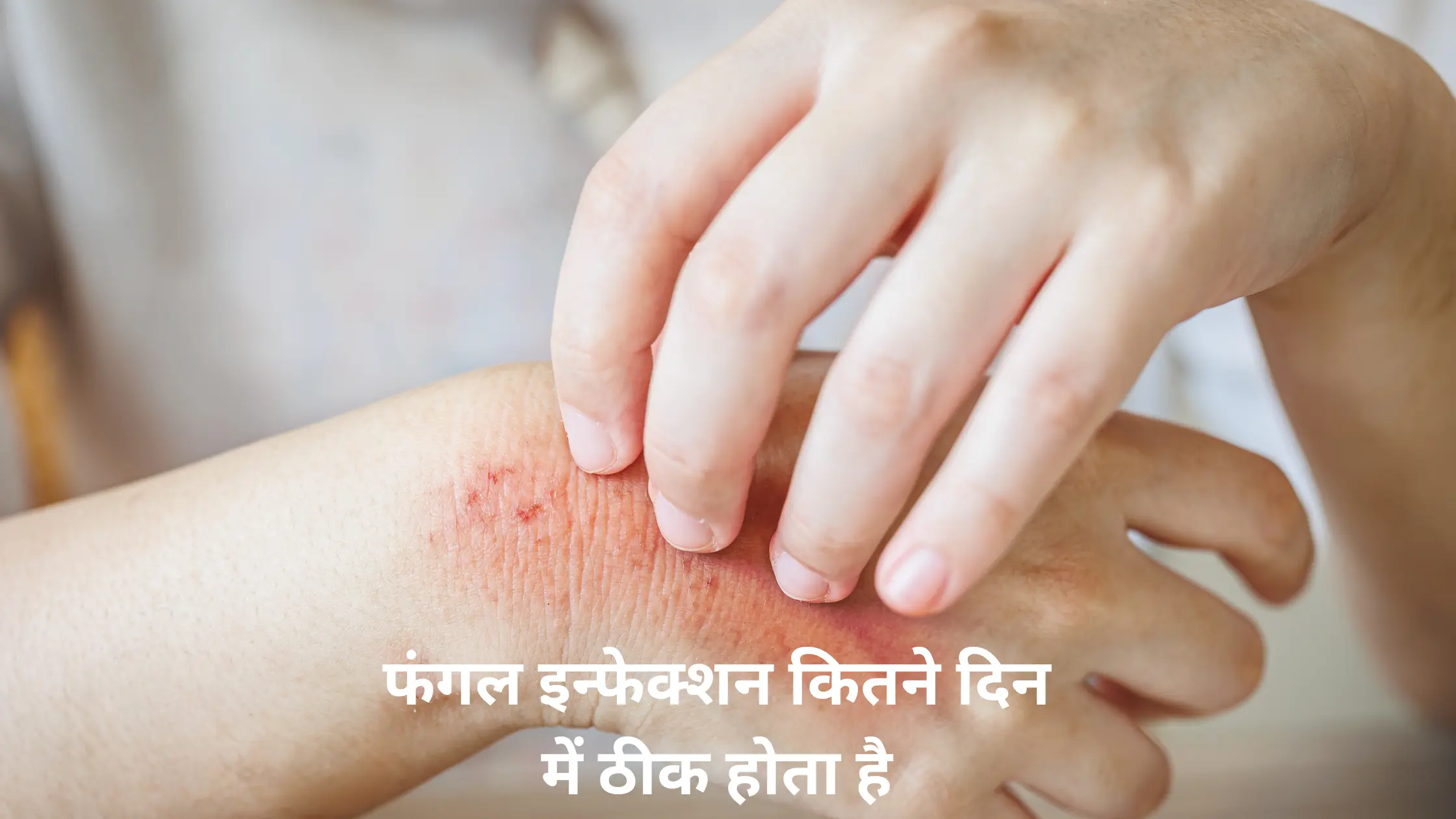 फंगल इन्फेक्शन कितने दिन में ठीक होता है