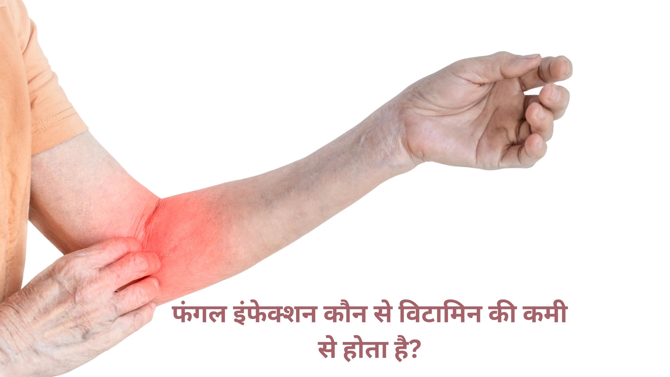 फंगल इंफेक्शन कौन से विटामिन की कमी से होता है?