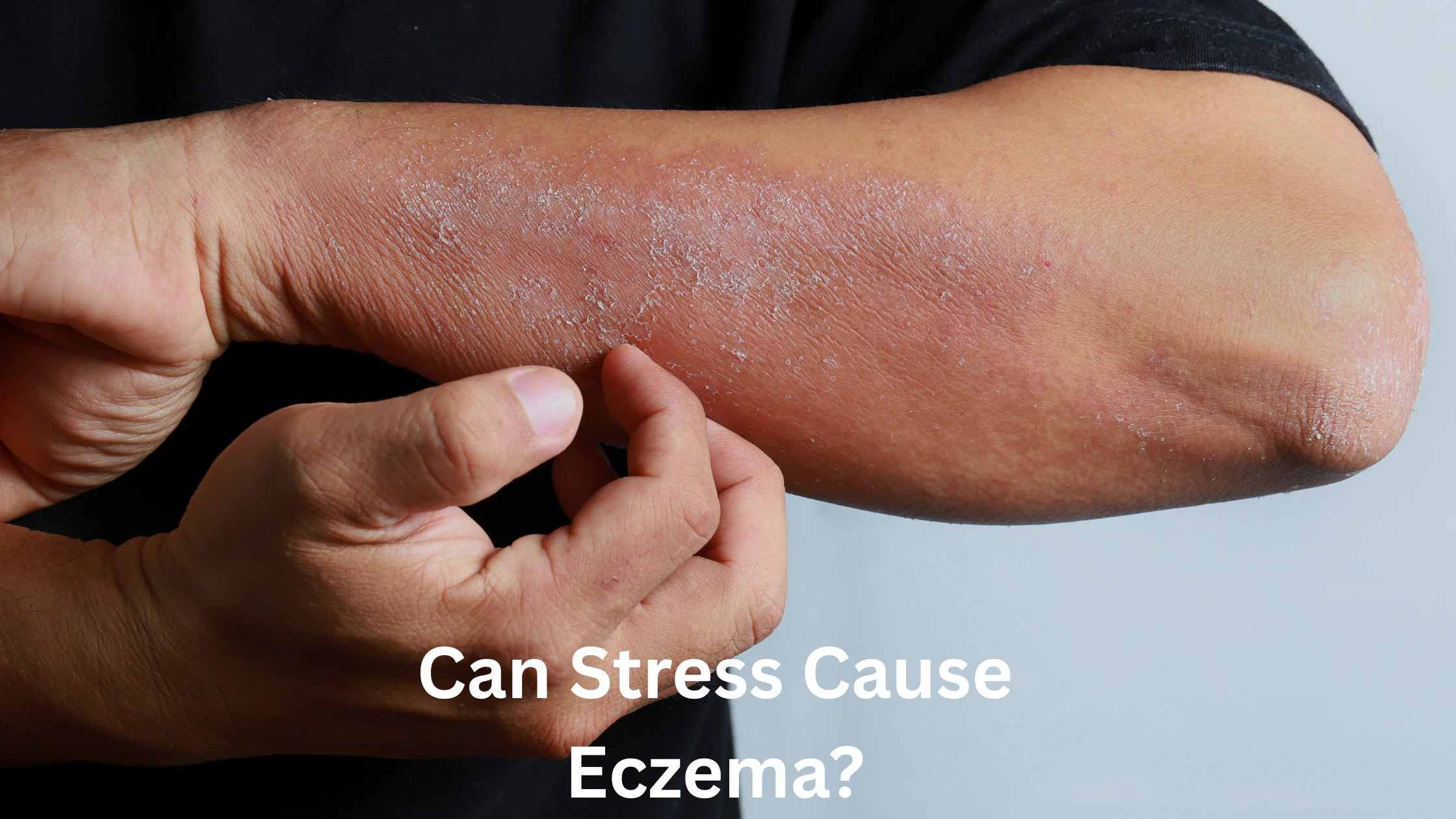Can Stress Cause Eczema?