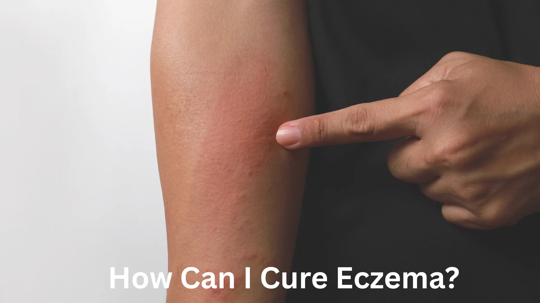 How Can I Cure Eczema