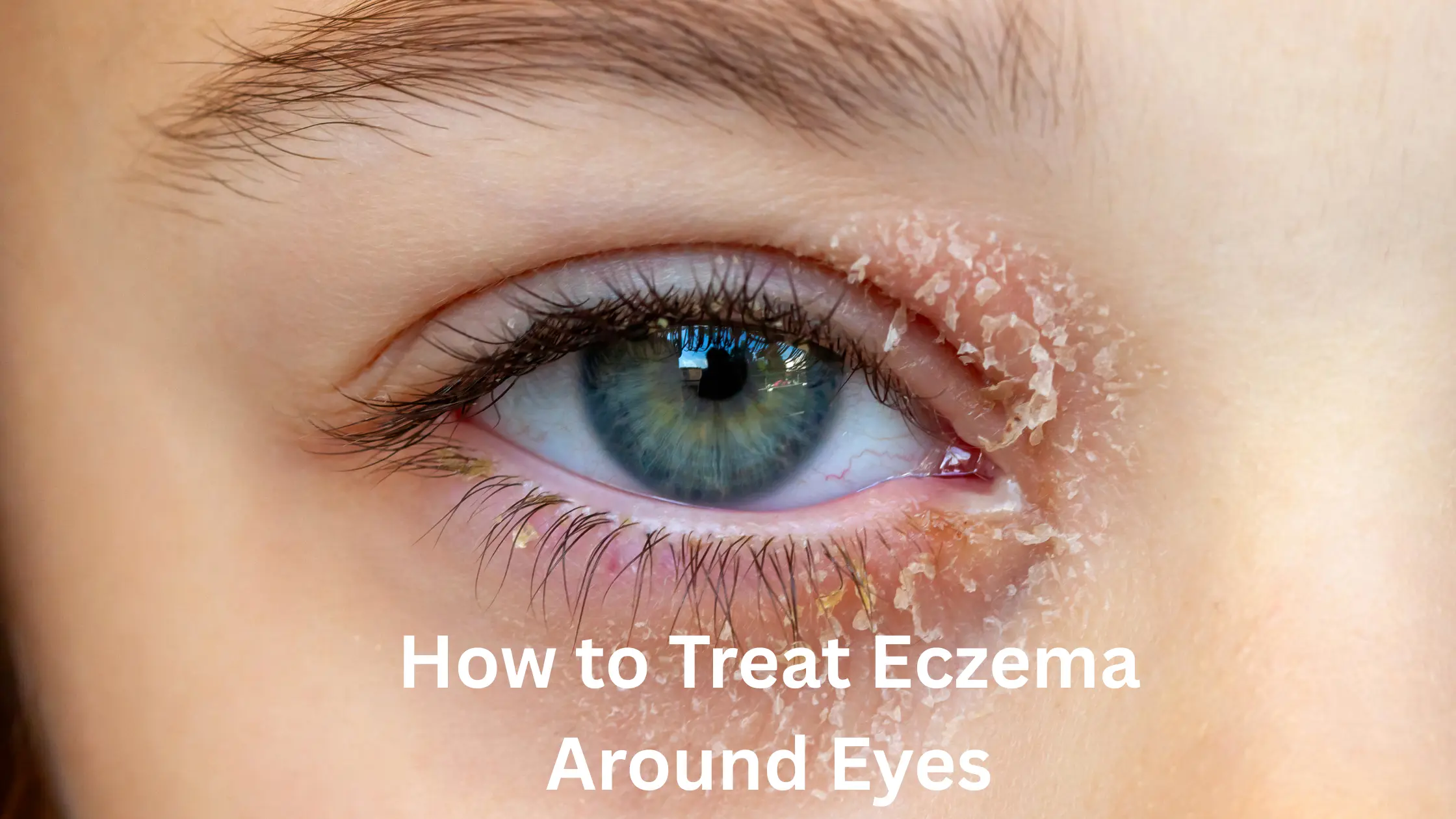 How to Treat Eczema Around Eyes