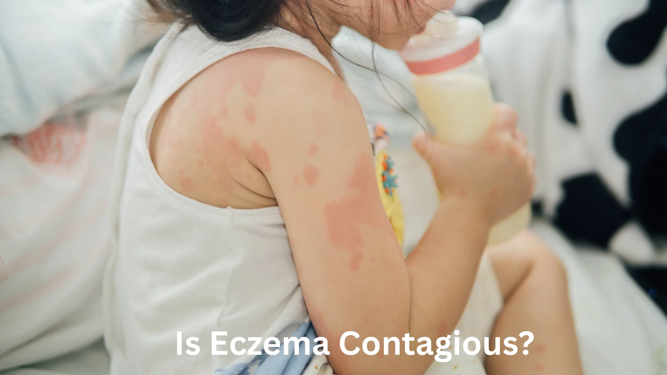 Is Eczema Contagious?
