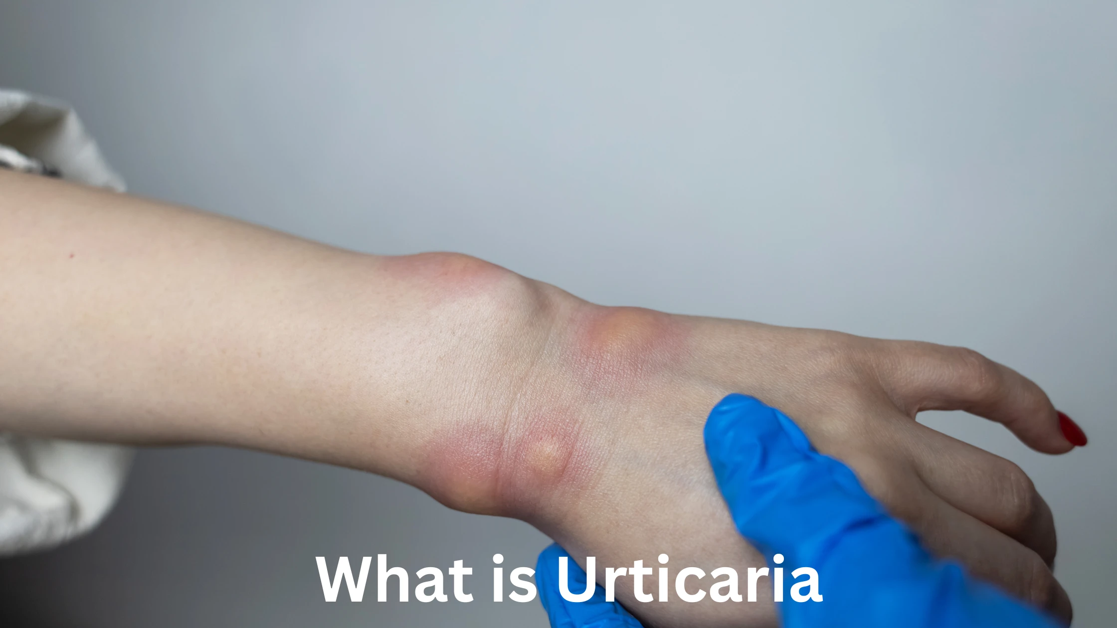 What is Urticaria?